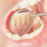 Plaque & Tartar Removers