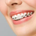 Braces Accessories