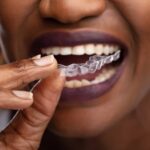 Clear Aligners & Accessories